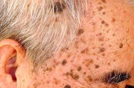 what is seborrheic keratosis and can it