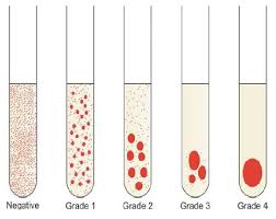 Determination Of Blood Group By Tube Method