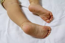 all about hand foot and mouth disease