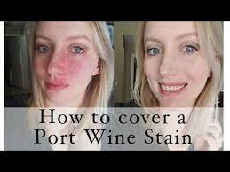 cover a port wine stain birthmark