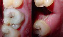 Check out these home remedies to stop tooth decay pain naturally. Tooth Decay Wikipedia
