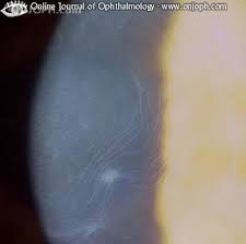 Overview anterior basement membrane dystrophy (abmd; Atlas Of Ophthalmology
