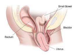 uterine prolapse uterus issues and