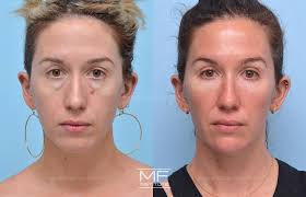 under eye filler midface rejuvenation