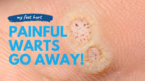 unsightly warts with advanced treatment