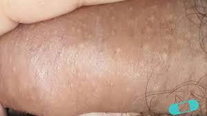 sebaceous glands fordyce spots or