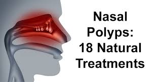 nasal polyps 18 natural treatments
