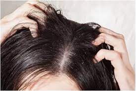 dandruff remes at home in marathi