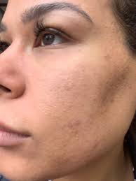 injectable filler for acne scars