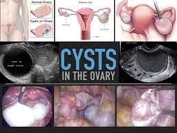 ovarian cysts anthony siow