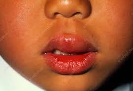 swollen lip of boy due to peanut