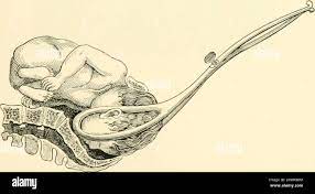 A textbook of obstetrics . Fig. 530.—The grip on the forceps.. Fig-  531-—The direction of the forceps-handles at the inferior strait 11 Lodge)  47 75* OBS TE TRIC OPERA TIONS. of course,
