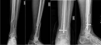 x rays of distal tibia fracture