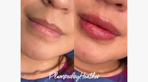 hyaluronic acid for lip injections
