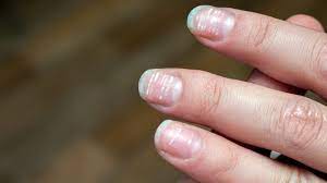 white spots on your nails