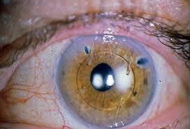 Check out the reviews and our extensive lens database. Can An Intraocular Lens Be Removed And Replaced