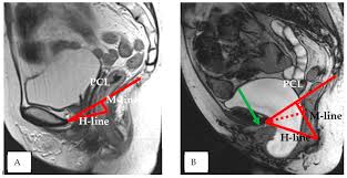 of the pelvic floor in prolapses