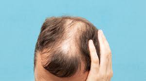 risk factors for androgenetic alopecia