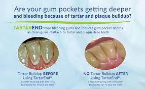 remove tartar plaque dental calculus