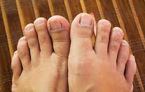 black toenails causes prevention tips