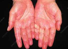 Palmar erythema is a reddening of the skin on the palmar aspect of the hands, usually over the hypothenar eminence. Palmar Erythema Keyword Search Science Photo Library