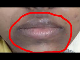 dark patches blackspots around lips