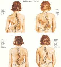 mild scoliosis learn how to stay ahead
