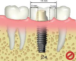 16 single tooth replacement treatment