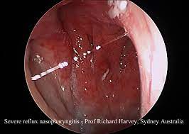 post nasal drip a chemical or viral