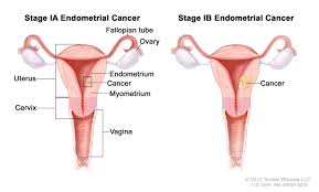It manifests in three ways; Definition Of Stage I Endometrial Cancer Nci Dictionary Of Cancer Terms National Cancer Institute