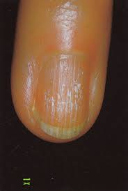 brittle nails iorizzo 2004