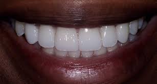How Do I Pick The Right Color Porcelain Veneers