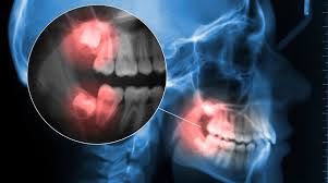 managing wisdom tooth pain effective