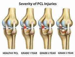 Medial knee ligament sprains are graded 1, 2 or 3 depending on the severity of the injury. Posterior Cruciate Ligament Pcl Tear Sun Orthopaedic