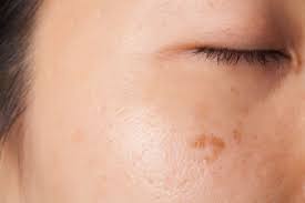 what causes brown spots on the skin