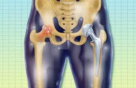 hip replacement surgery procedure