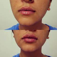 lip augmentation post injection after