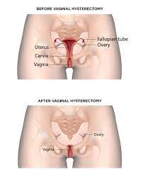 inal hysterectomy and pelvic floor