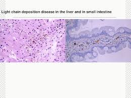 Light Chain Deposition Disease Ppt Download