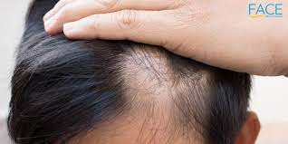 can too much collagen cause hair loss