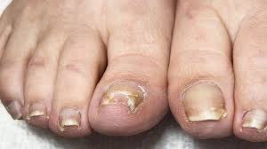 big toenail repair pedicure tutorial at