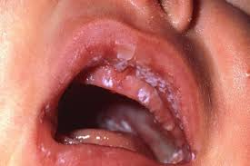 Kết quả hình ảnh cho bệnh tưa lưỡi ở trẻ em