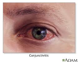 allergic conjunctivitis information