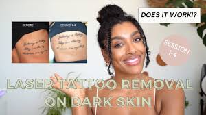laser tattoo removal on darker skin