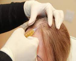 مزوتراپی مو چیست و چگونه انجام می شود؟