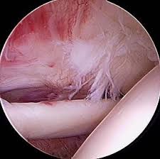 Dans le cas d'une rupture totale ou partielle d'un tendon rotulien ou quadricipital, la chirurgie est obligatoire. Coiffe Des Rotateurs Ou Rupture Du Tendon De L Epaule Orthopedie Roulers