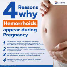 hemorrhoids appear during pregnancy
