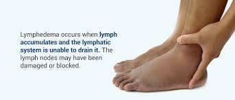 primary vs secondary lymphedema