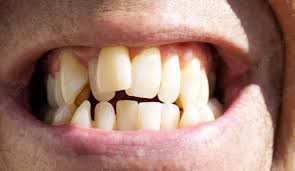 straighten crooked teeth naturally