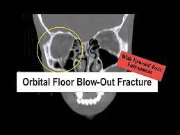 fracture with upward gaze entrapment